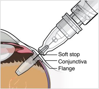 Roche Receives Positive CHMP Opinion for Susvimo Sustained-Release Wet AMD Treatment