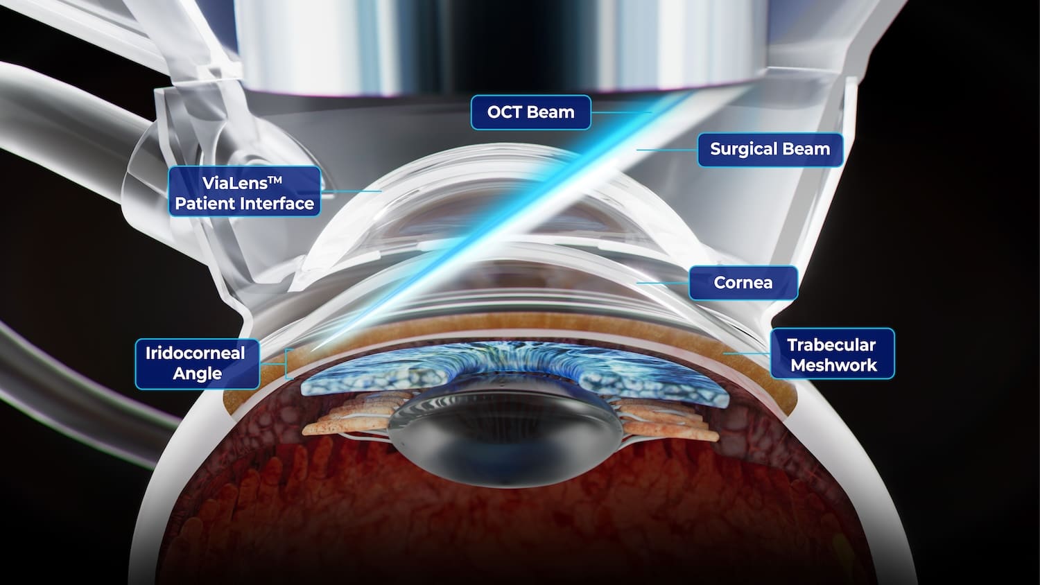 ViaLase Gains CE Marking for Femtosecond Laser for Glaucoma Treatment