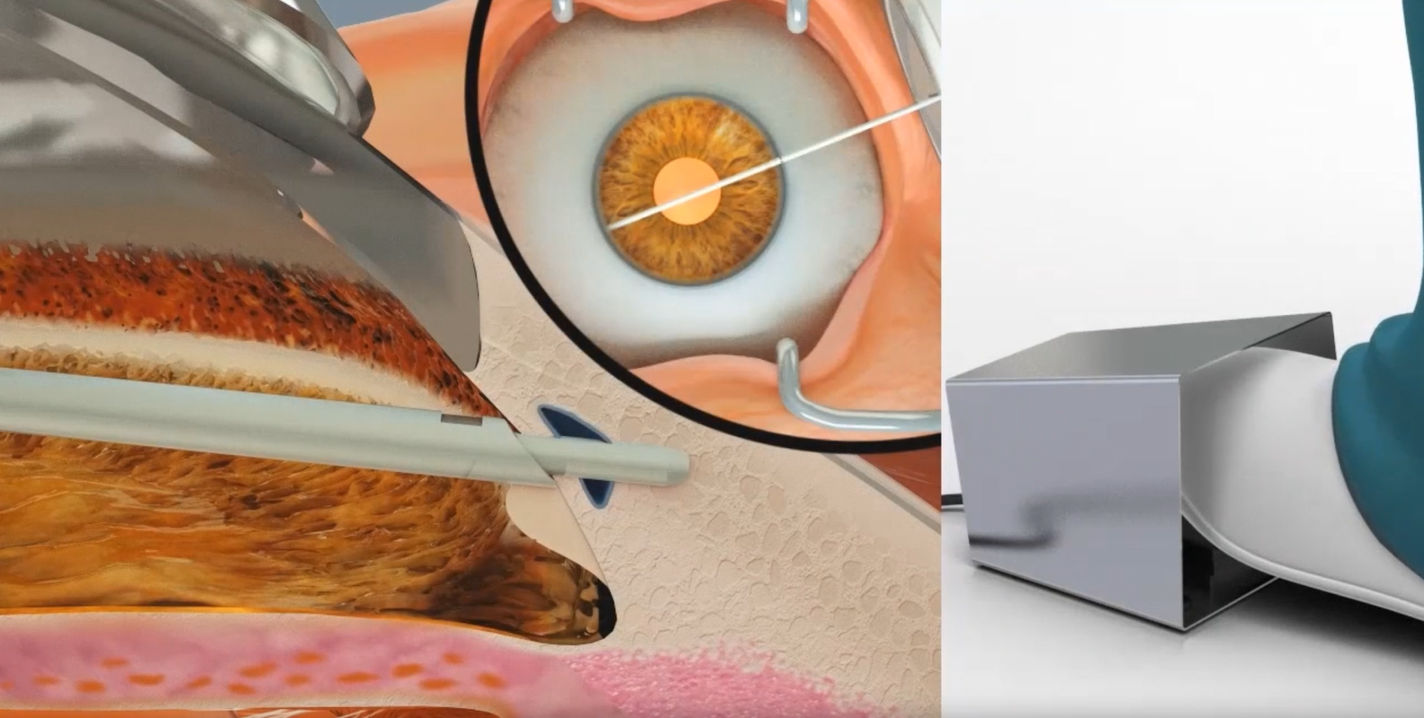 Sanoculis Receives CE Marking for MINT Procedure for Glaucoma