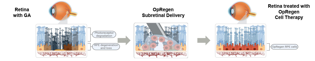 OpRegen’s Phase I/IIa Trial in GA Shows Mean Improvement in VA Through 36 Months