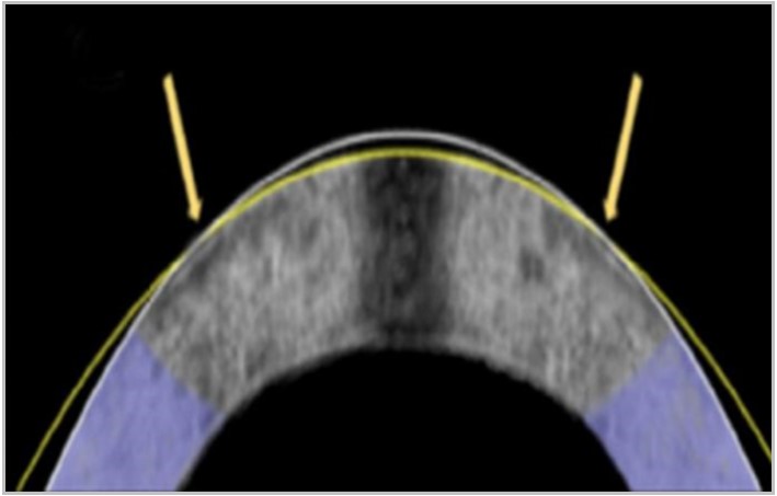 Researchers See Early Promise in Electromechanical Reshaping of Cornea