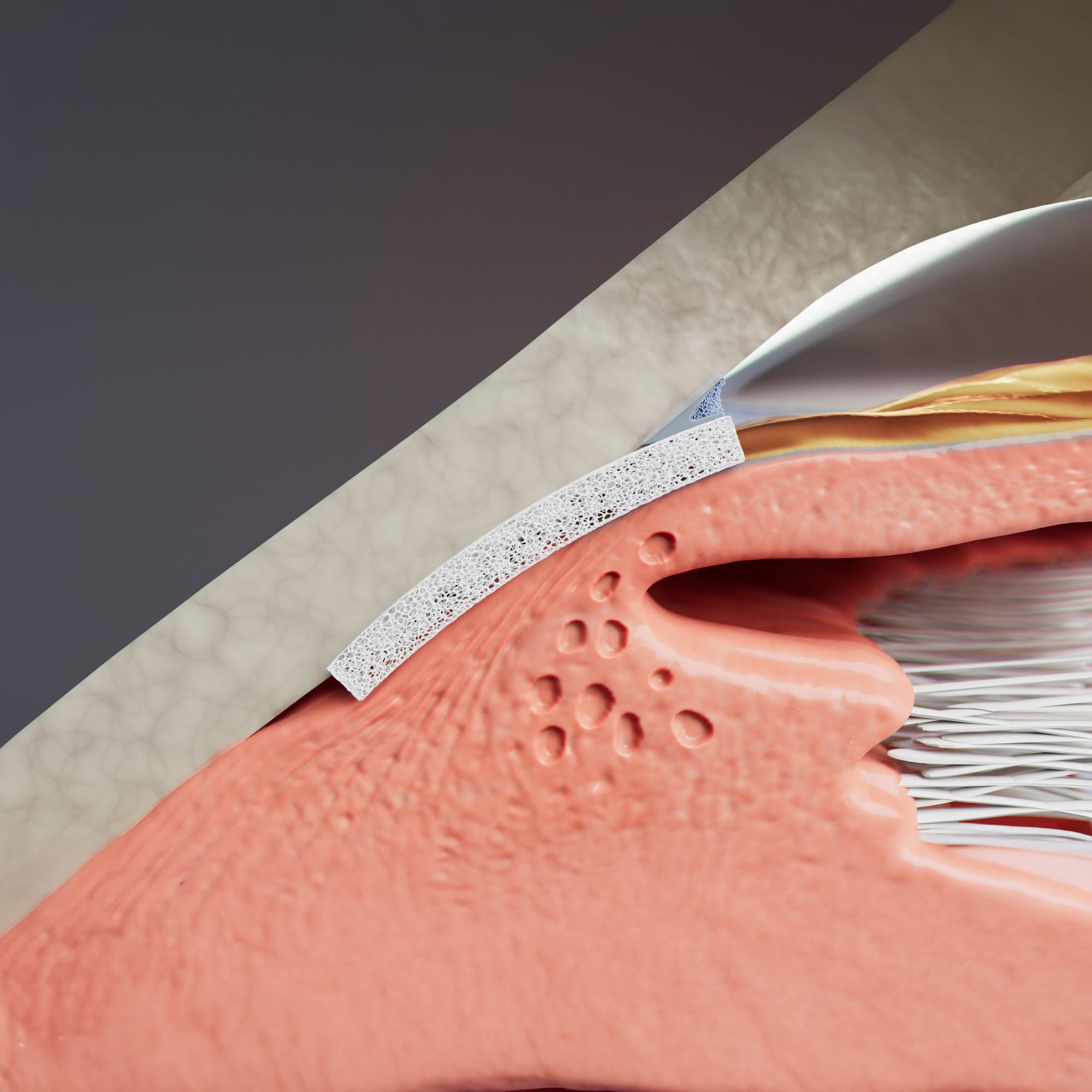 Iantrek Announces US Commercial Launch of AlloFlo Uveo Biostent