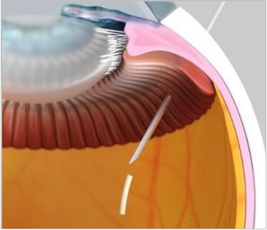Ocular Therapeutix Takes Cue from FDA, Will Submit NDA for Axpaxli After Single Phase III Trial