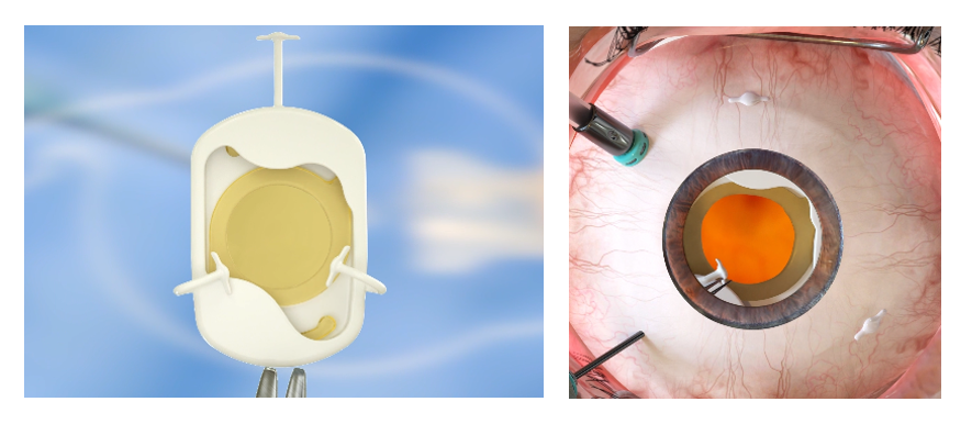 US FDA Gives Green Light to Trial of Long Bridge’s Prosthetic Capsular Bag