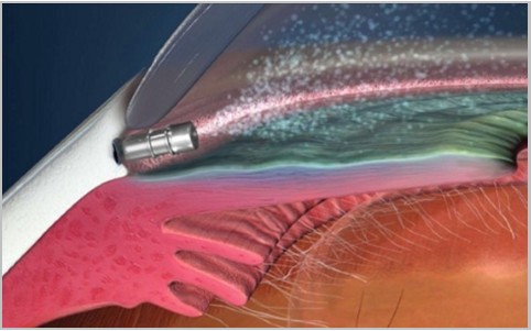 MACs Propose Limiting Coverage for iDose TR in Glaucoma Patients